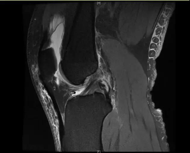 【有声病例】后交叉韧带断裂