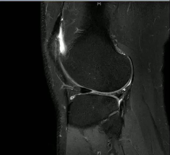 【有声病例】前交叉韧带断裂