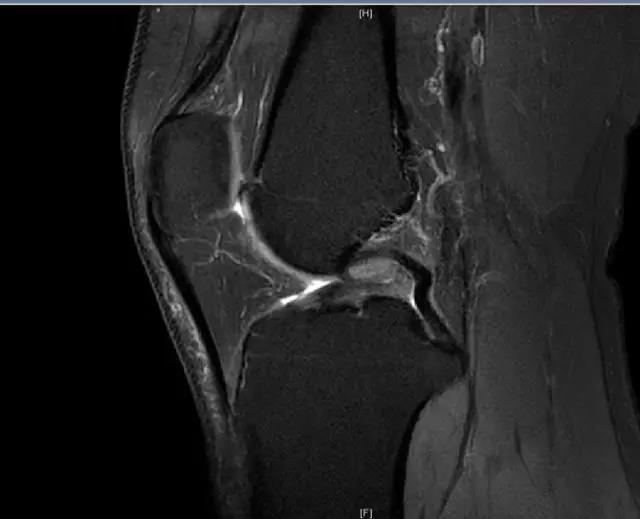 【有声病例】前交叉韧带断裂，外侧半月板后角撕裂
