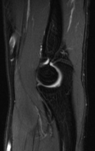 肘关节-fs T2