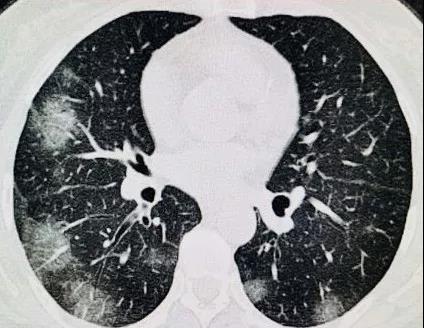 朗润战疫|新冠CT征象识别及特点